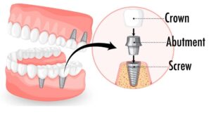 Dental Implants